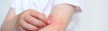 Celiaquía y dermatitis herpetiforme.